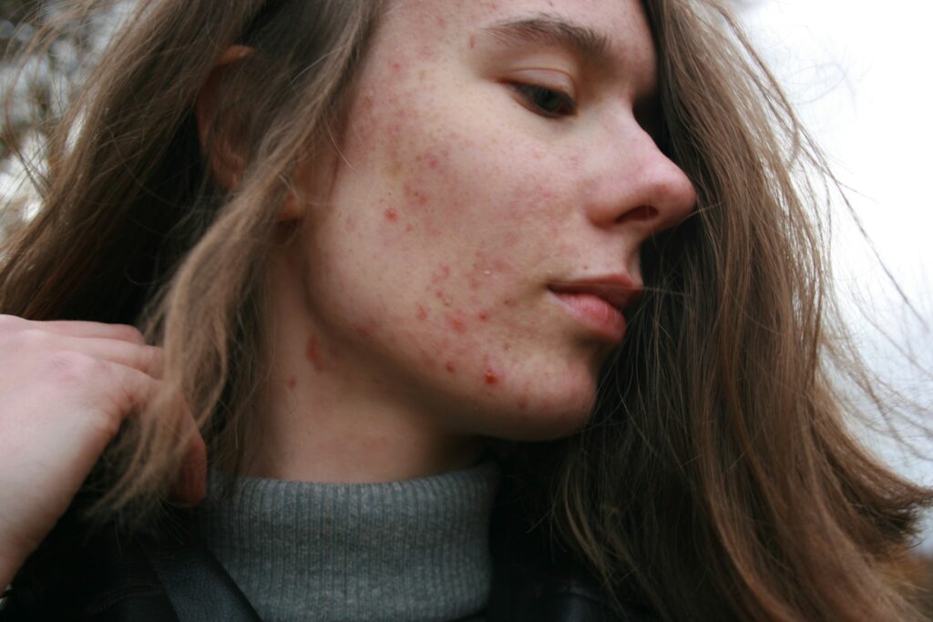 Effective Strategies for Managing Persistent Acne