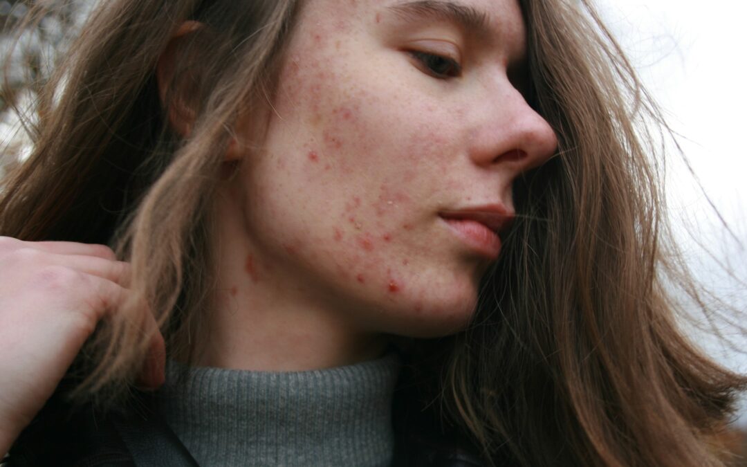 Effective Strategies for Managing Persistent Acne